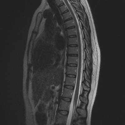 МРТ снимок нормального позвоночника